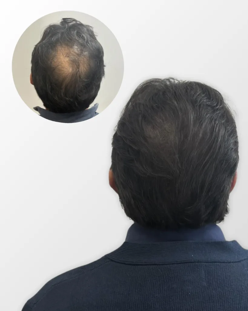 efecto densidad micropigmentación capilar