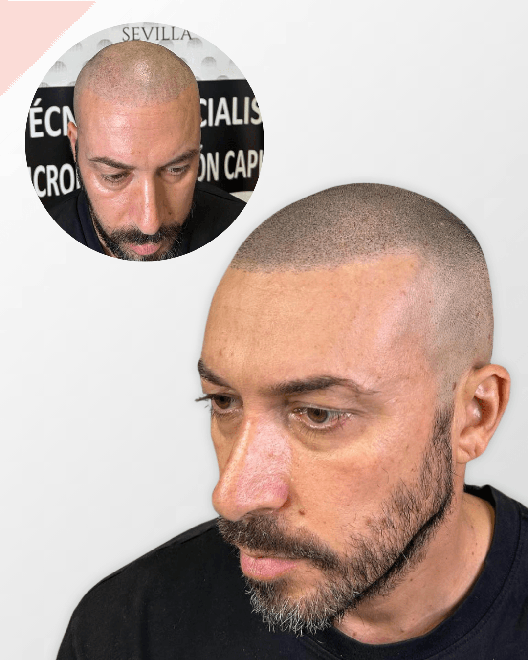 efecto rapado micropigmentación capilar